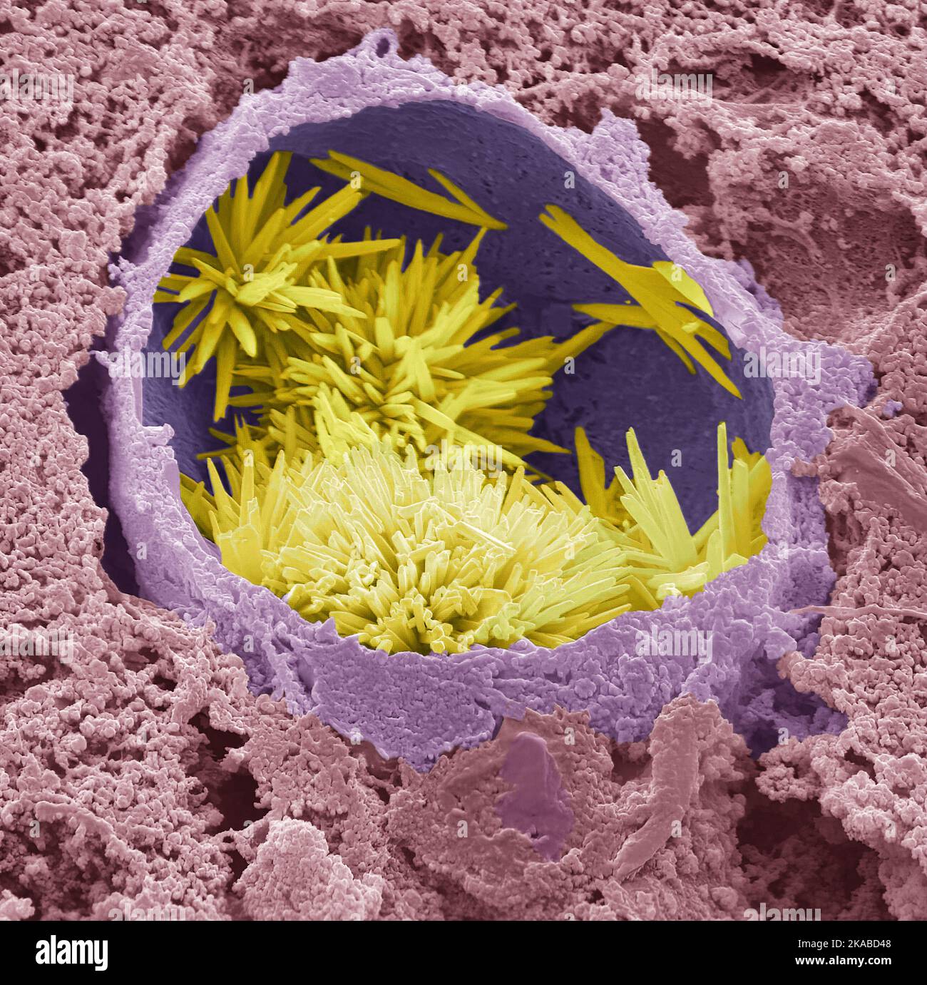 Cholesterol crystals in liver, SEM Stock Photo