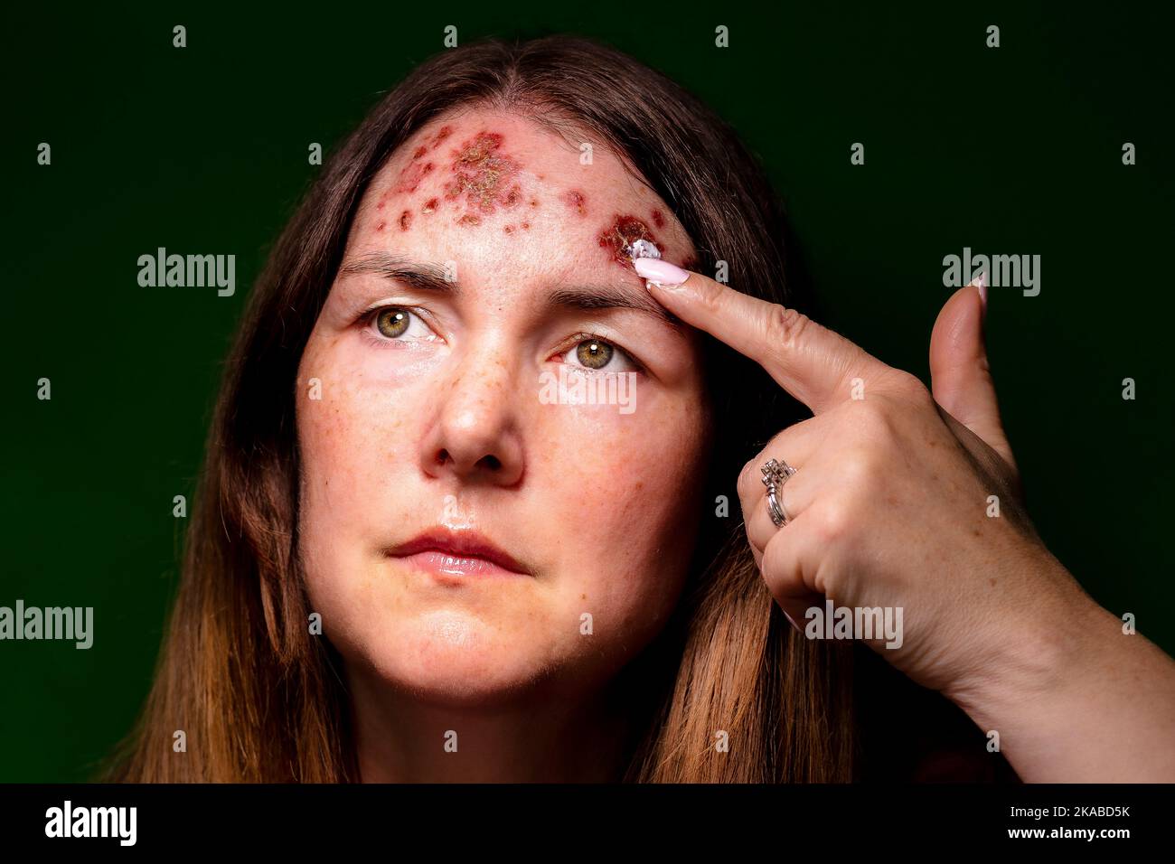 Patient with basal cell carcinoma on the forehead Stock Photo Alamy