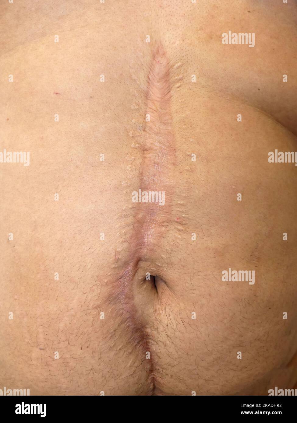 Large scar on the abdomen due to major surgery Stock Photo