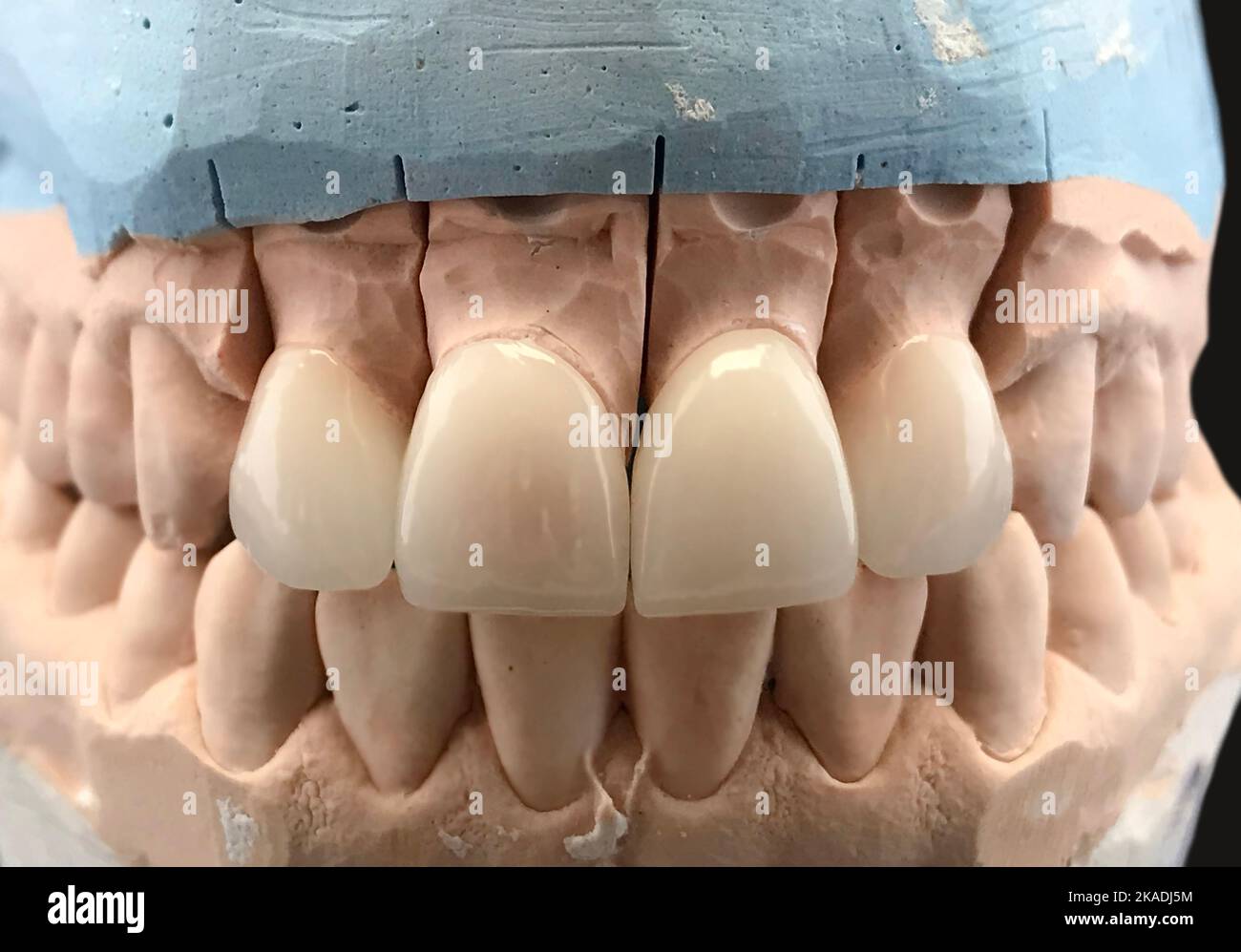 Artificial jaw with a ceramic crown on implants, stands on a surgical