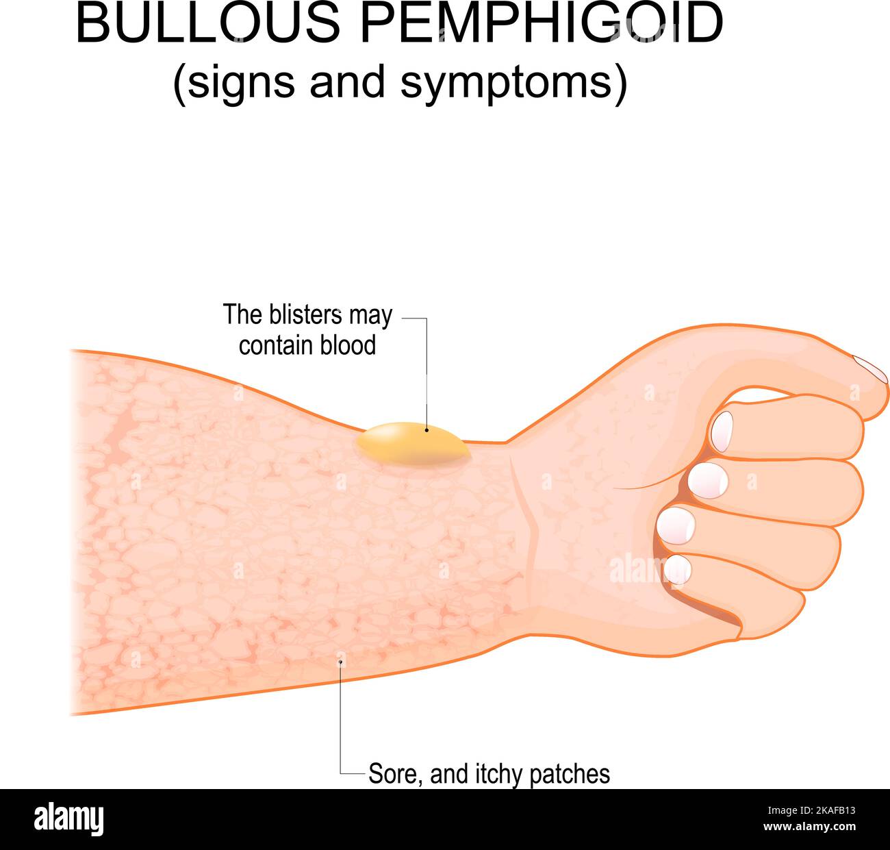 Bullous pemphigoid. autoimmune pruritic skin disease. skin condition of older people. It starts with an itchy rash than, blisters can form on the skin Stock Vector