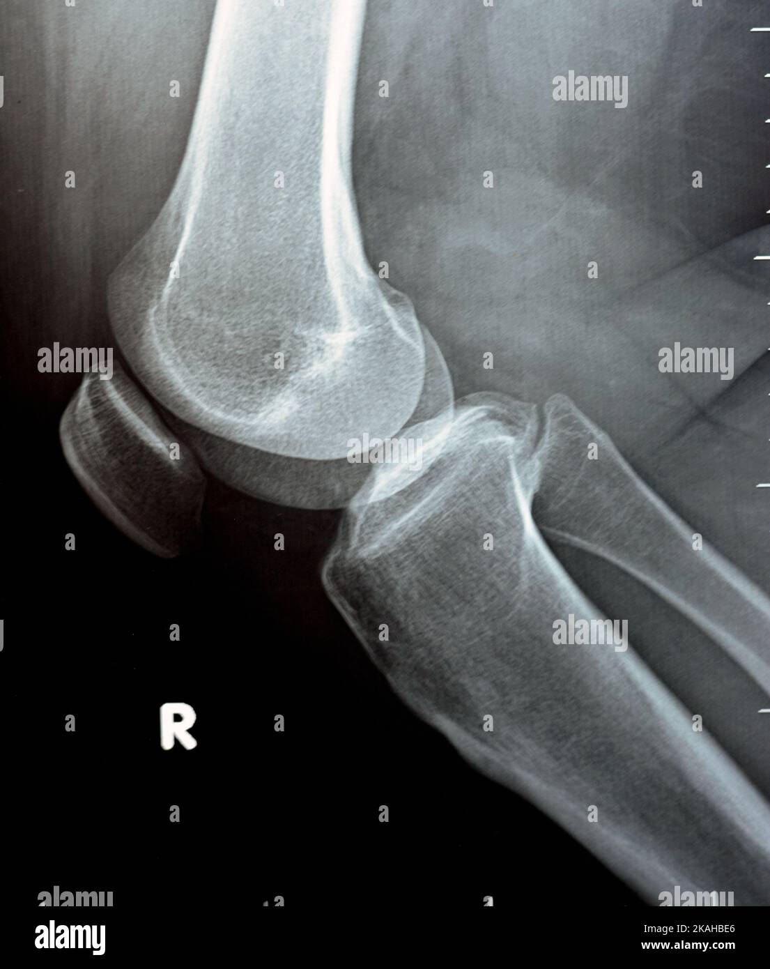 plain x ray on knee joint showing joint space narrowing and Subchondral Sclerosis on medial compartment (thickening of bone that happens in joints aff Stock Photo