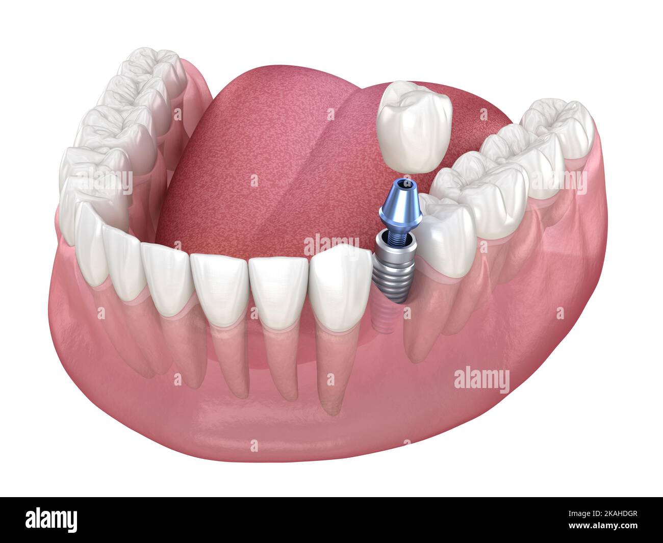 Premolar tooth recovery with implant. Medically accurate 3D
