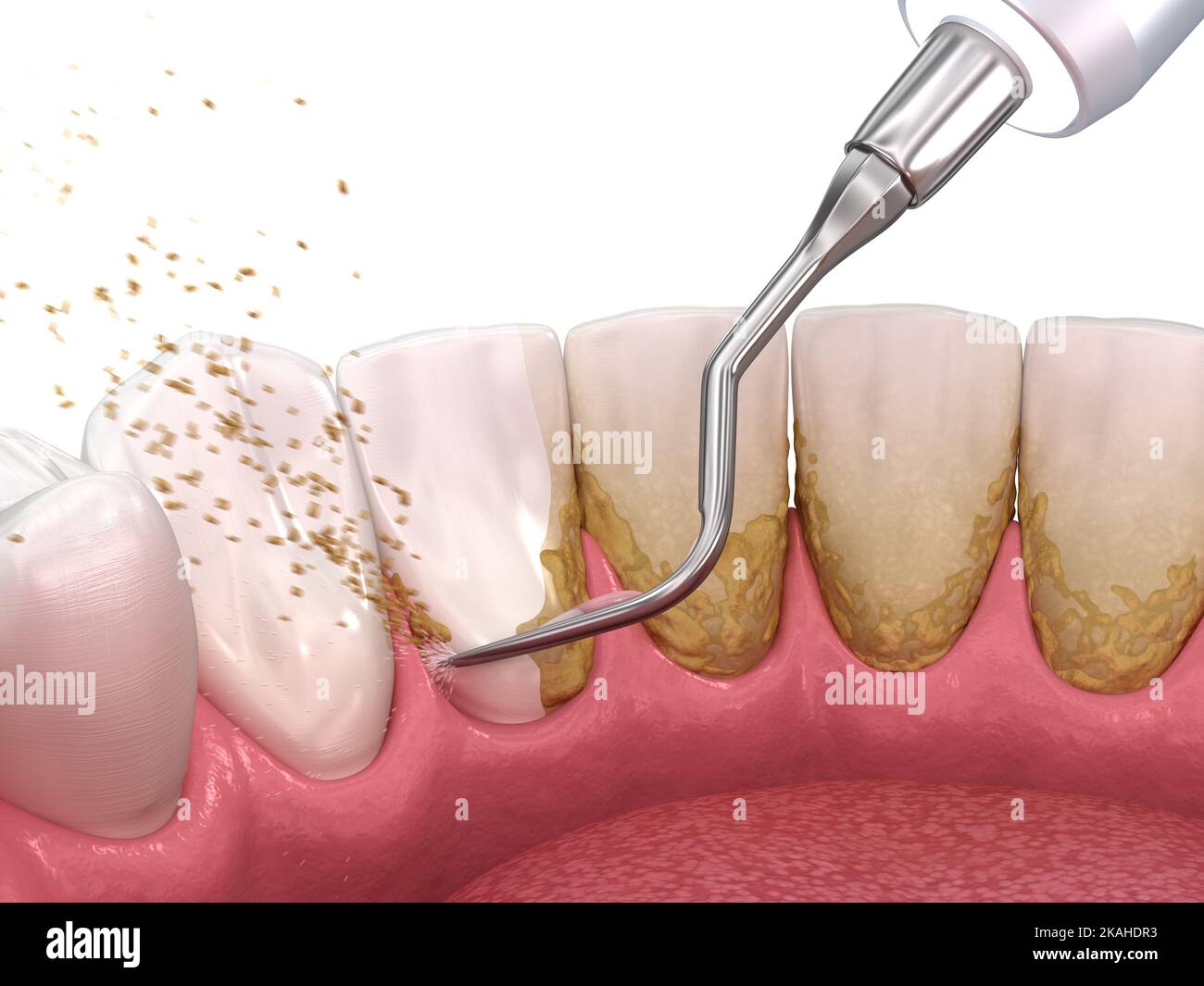 Oral hygiene Scaling and root planing (conventional periodontal