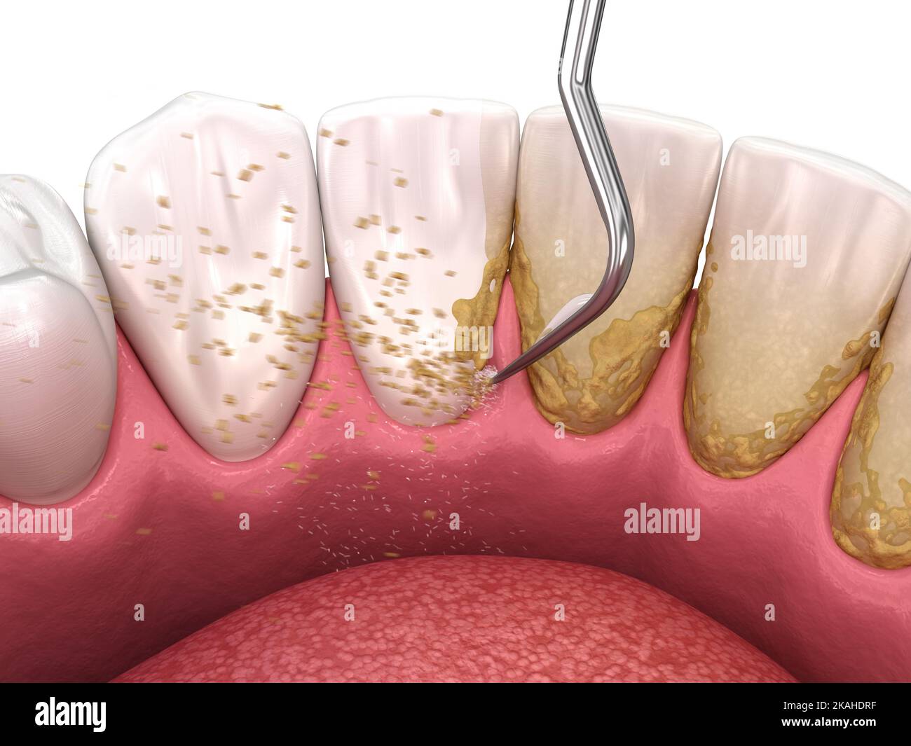 Oral hygiene Scaling and root planing (conventional periodontal