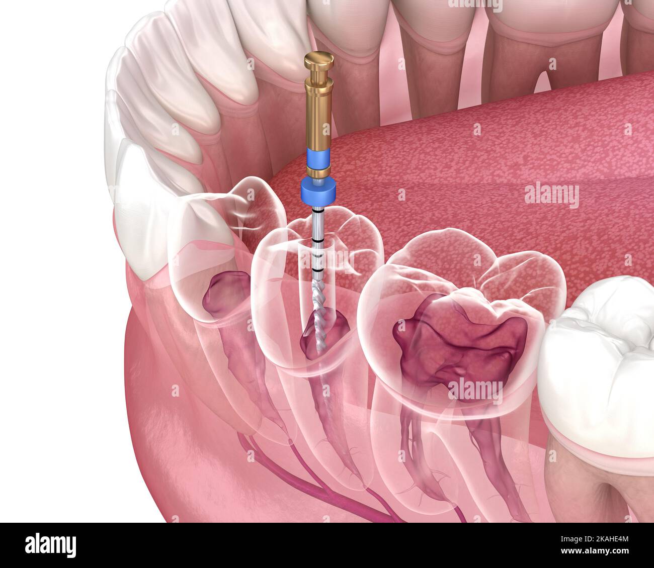 Endodontic root canal treatment process. Medically accurate tooth 3D