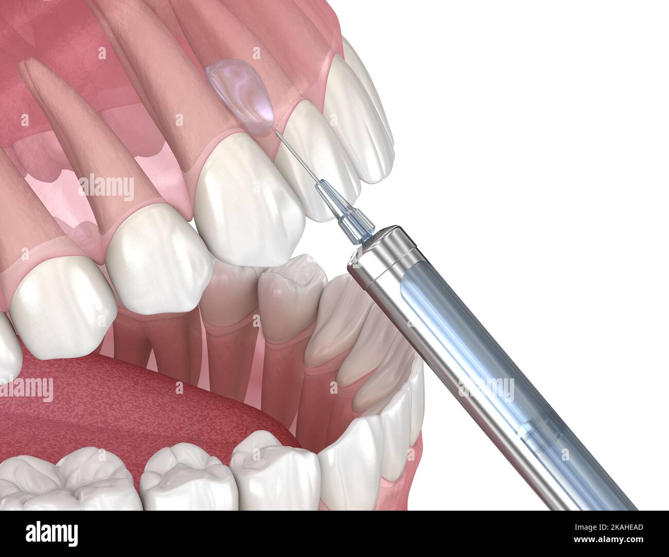 Local Dental anesthesia. 3D illustration of dental treatment Stock