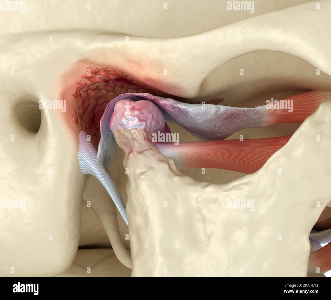 Tmj dislocation hi-res stock photography and images - Alamy