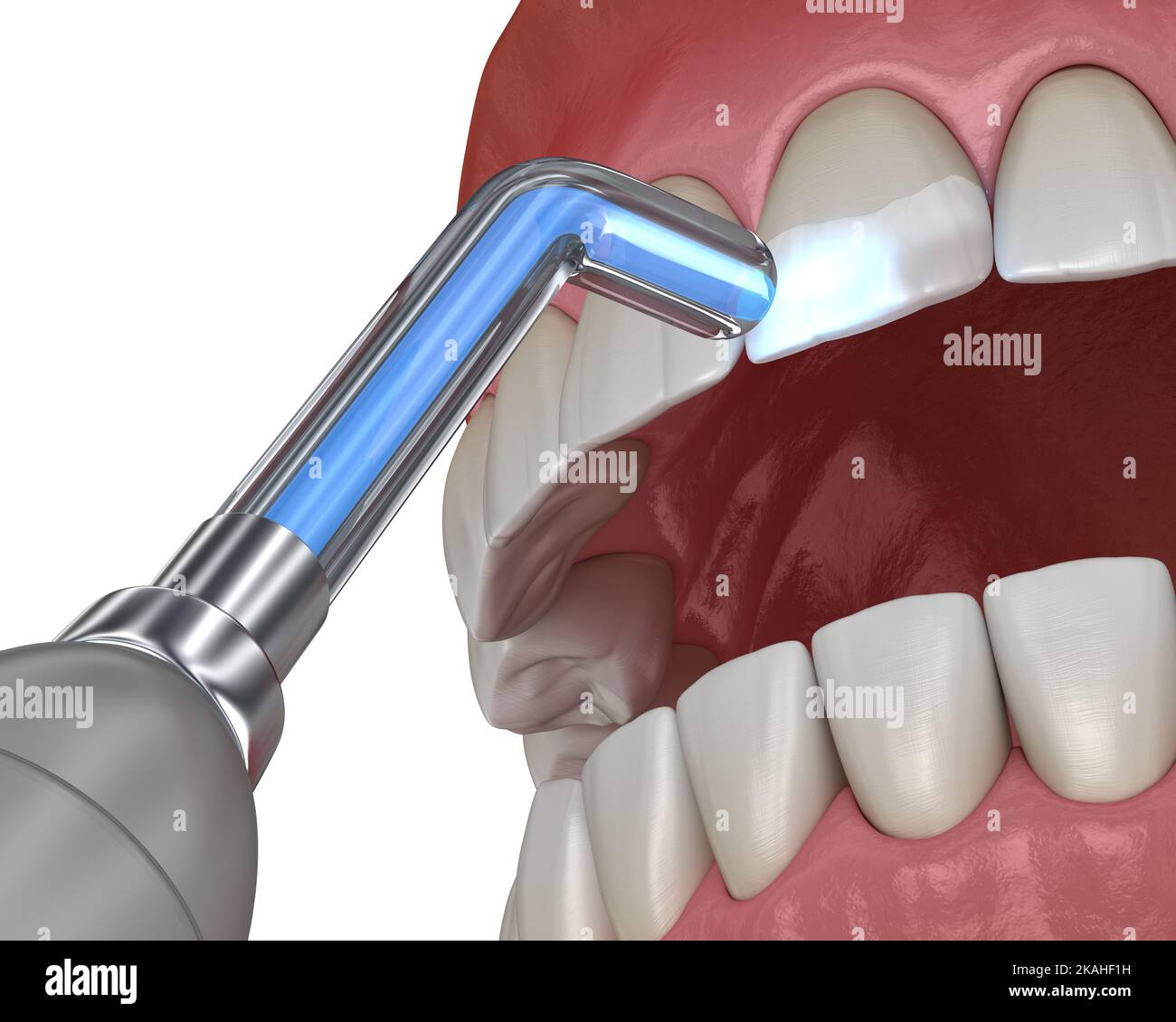 Tooth restoration with filling and polymerization lamp. Medically
