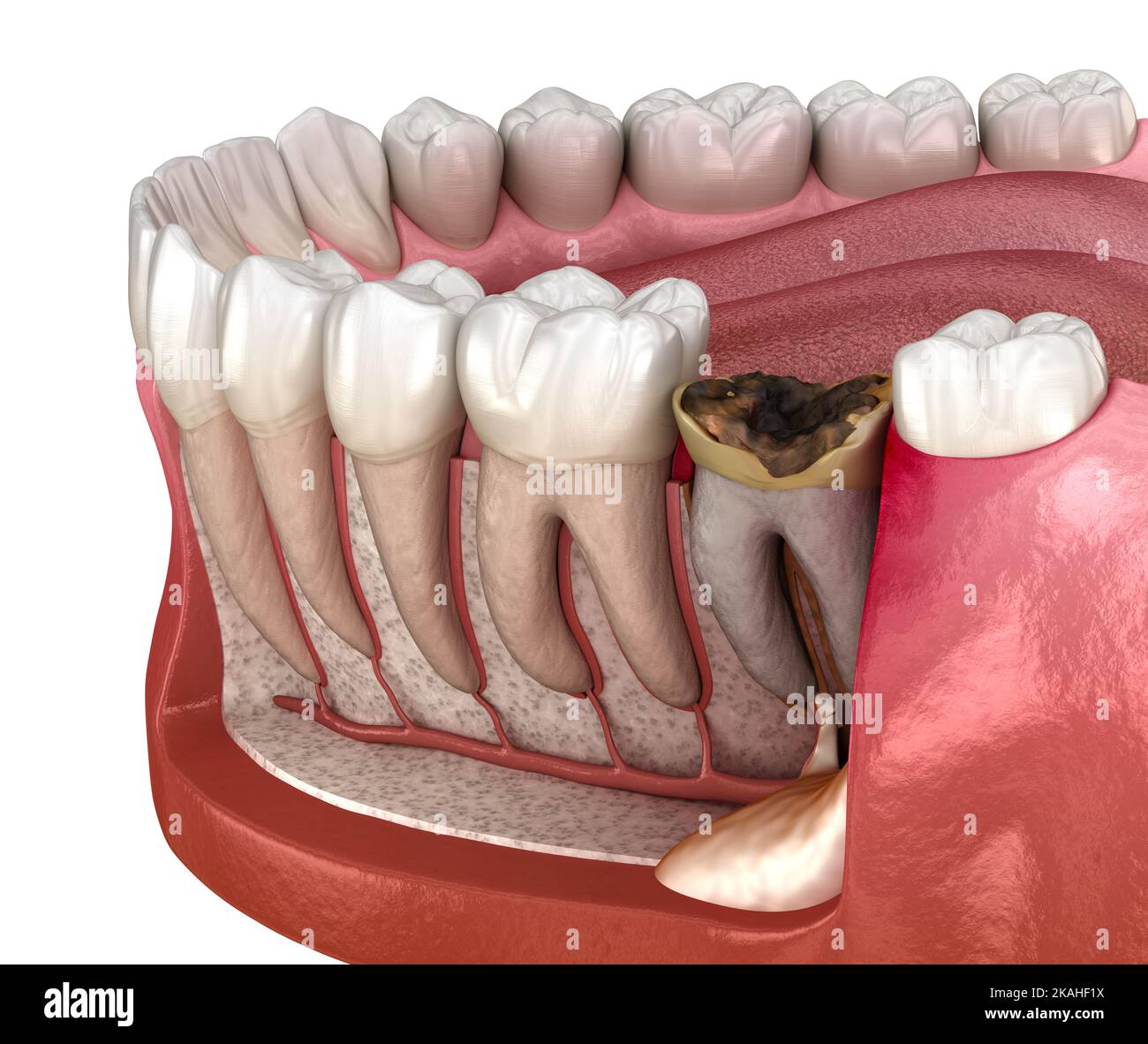 Periostitis tooth Lump on Gum Above Tooth. Medically accurate dental