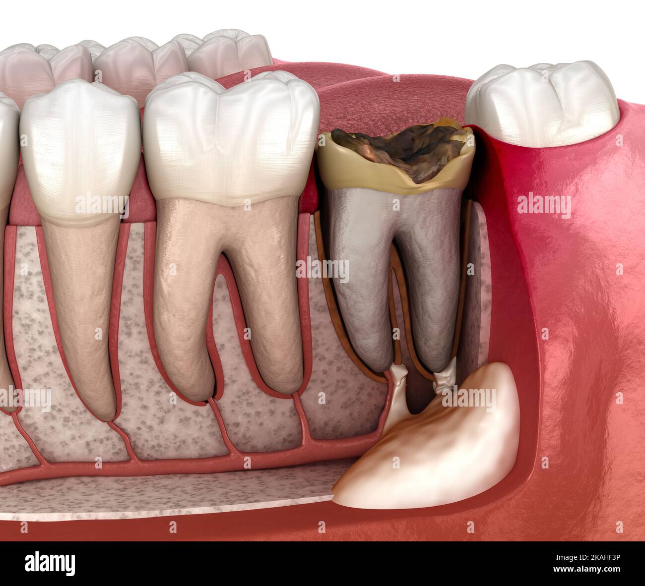 Periostitis tooth Lump on Gum Above Tooth. Medically accurate dental