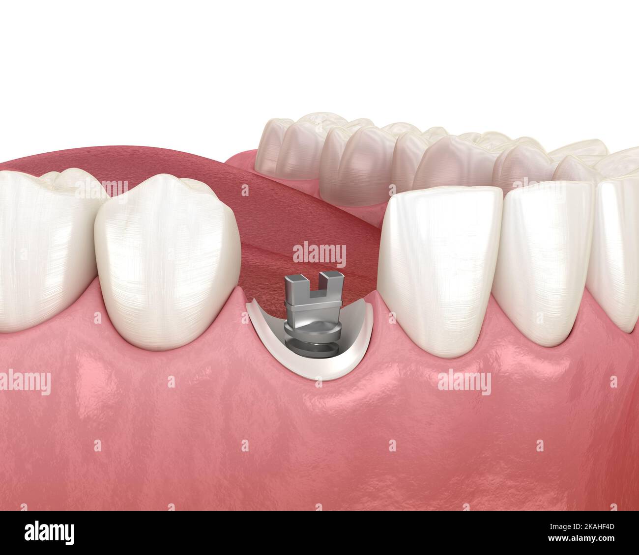 Dental steel post installation in to incisor tooth. Dental endodontic