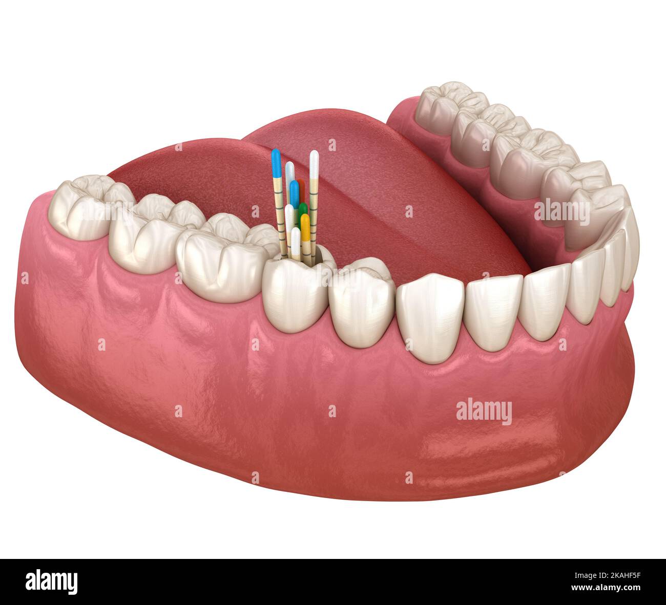 Gutta percha root canal treatment process. Medically accurate tooth 3D