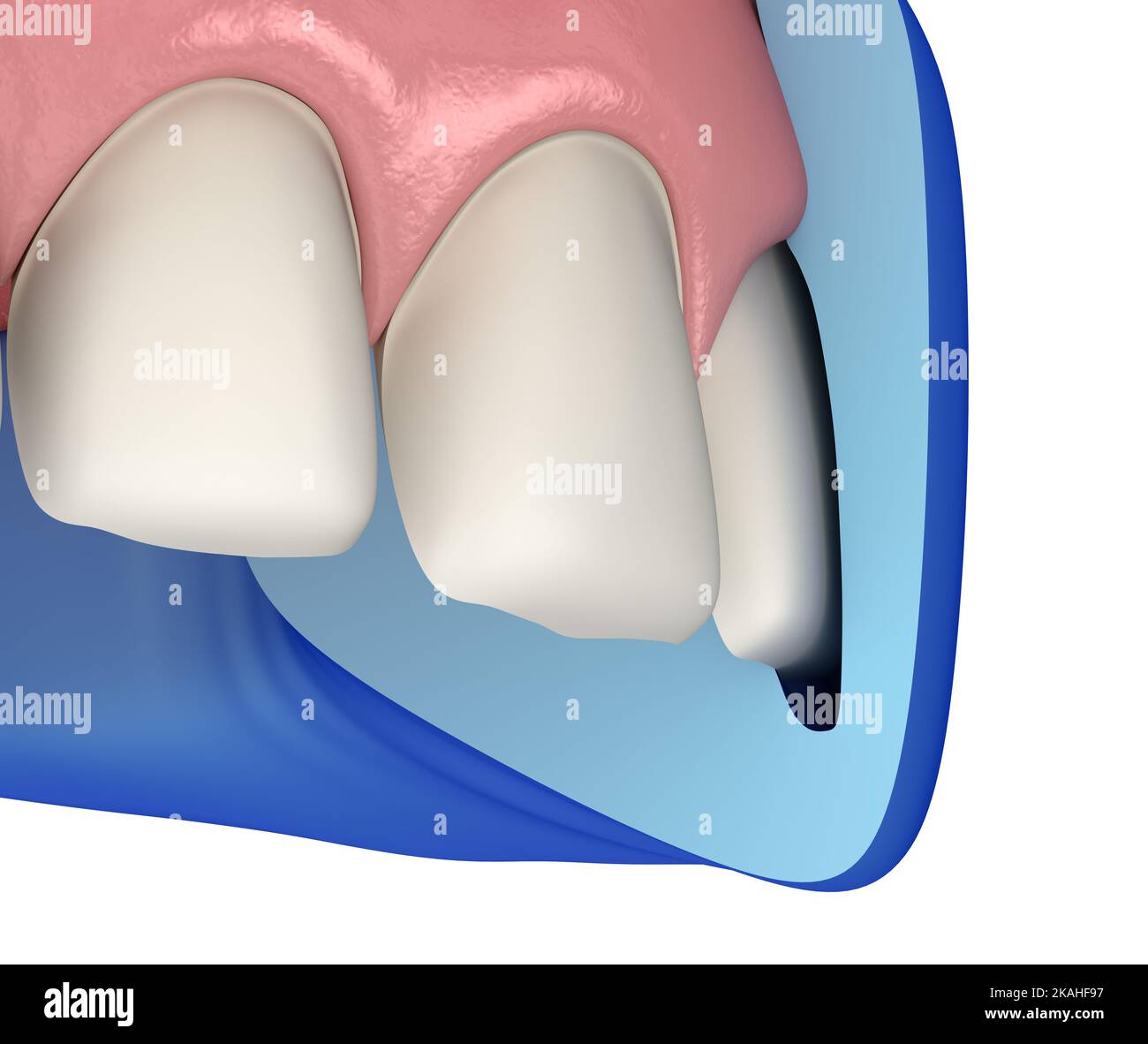 Crosssection of Mockup dental key and prepareted incisor. Medically