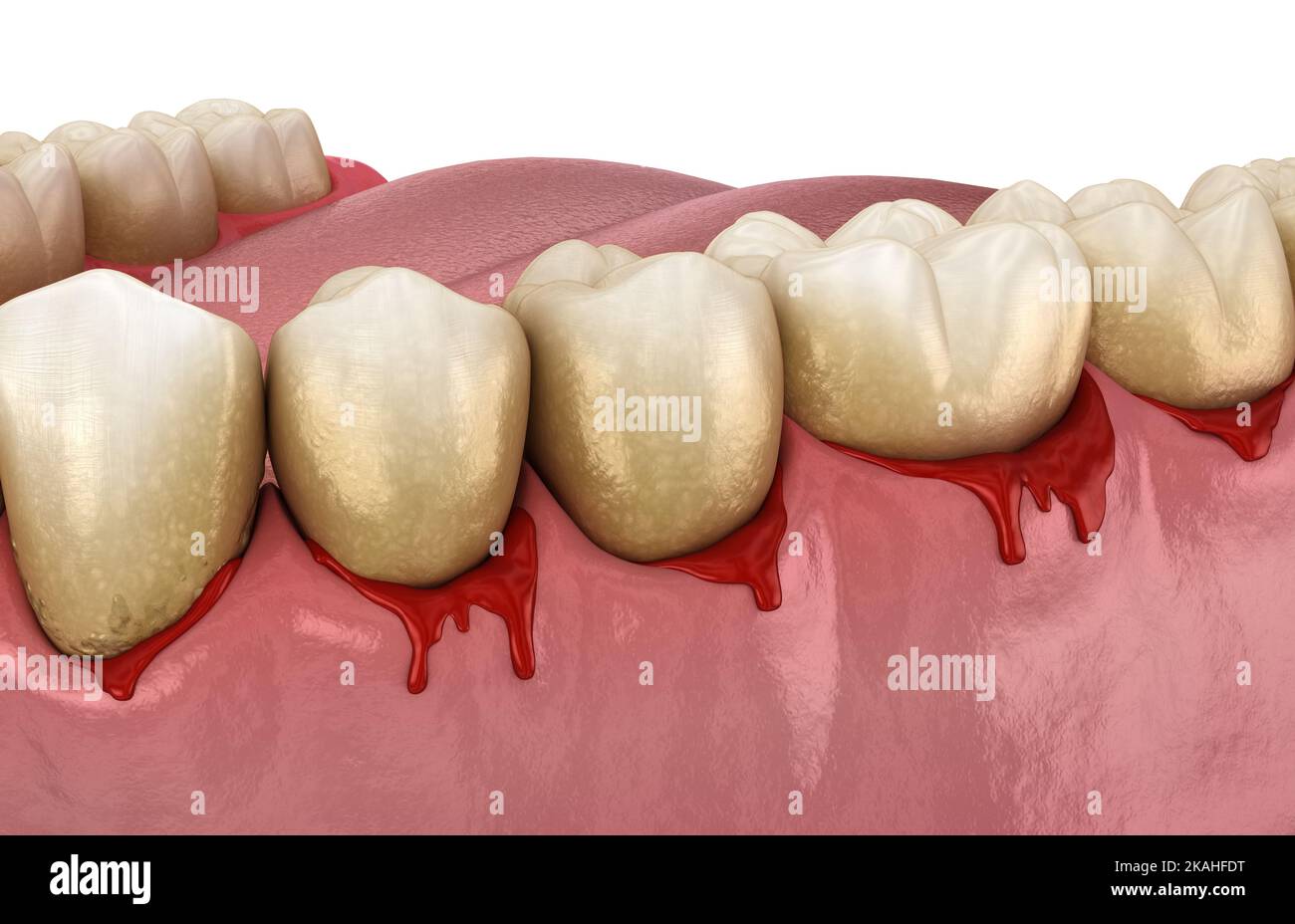 Bleeding gums or Periodontal pathological inflammatory condition of