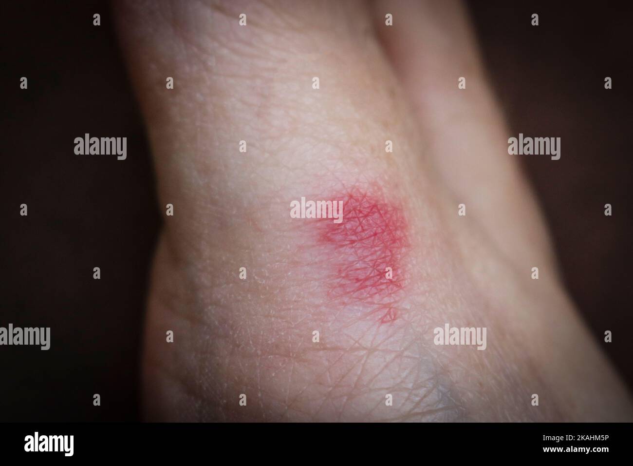 Ant bite on the skin of the foot. Red inflammation from damage to human