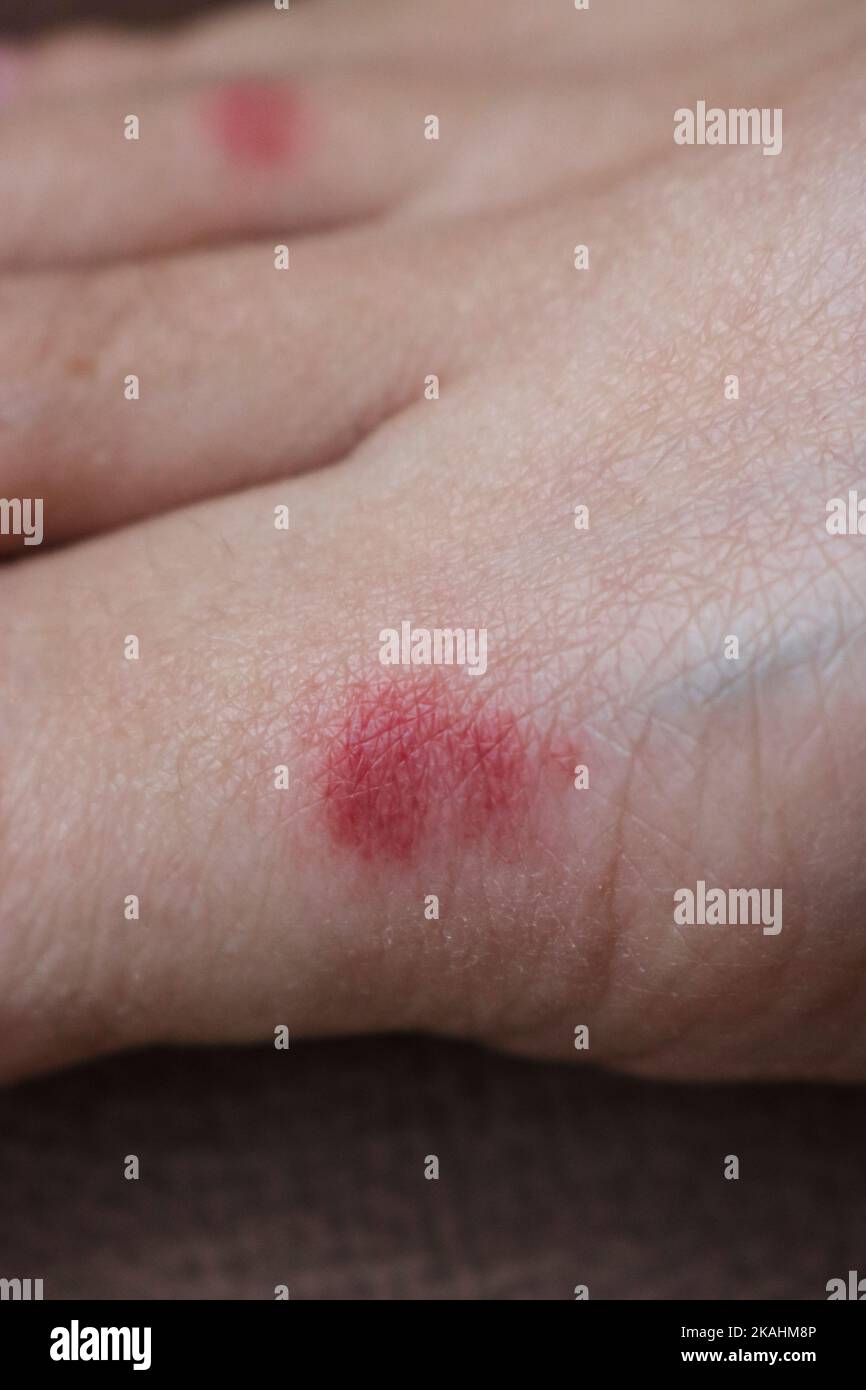 Red inflammation from damage to human skin after an insect bite. An ant