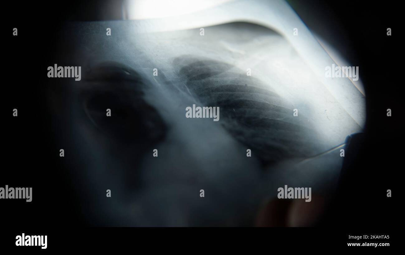 Xray extreme closeup, doctor making examinations on xray, medicine and health care concept