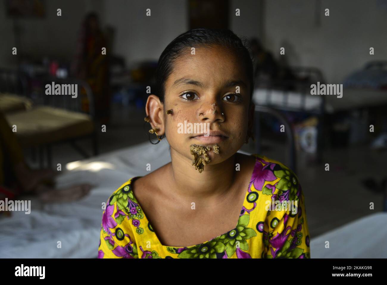 In this photograph taken on January 30, 2017, Bangladeshi patient Sahana Khatun, 10, poses for a photograph at the Dhaka Medical College and Hospital. A young Bangladeshi girl with bark-like warts growing on her face could be the first female ever afflicted by so-called 'tree man syndrome', doctors studying the rare condition said January 31. Ten-year-old Sahana Khatun has the tell-tale gnarled growths sprouting from her chin, ear and nose, but doctors at Dhaka's Medical College Hospital are still conducting tests to establish if she has the unusual skin disorder. (Photo by Mamunur Rashid/NurP Stock Photo