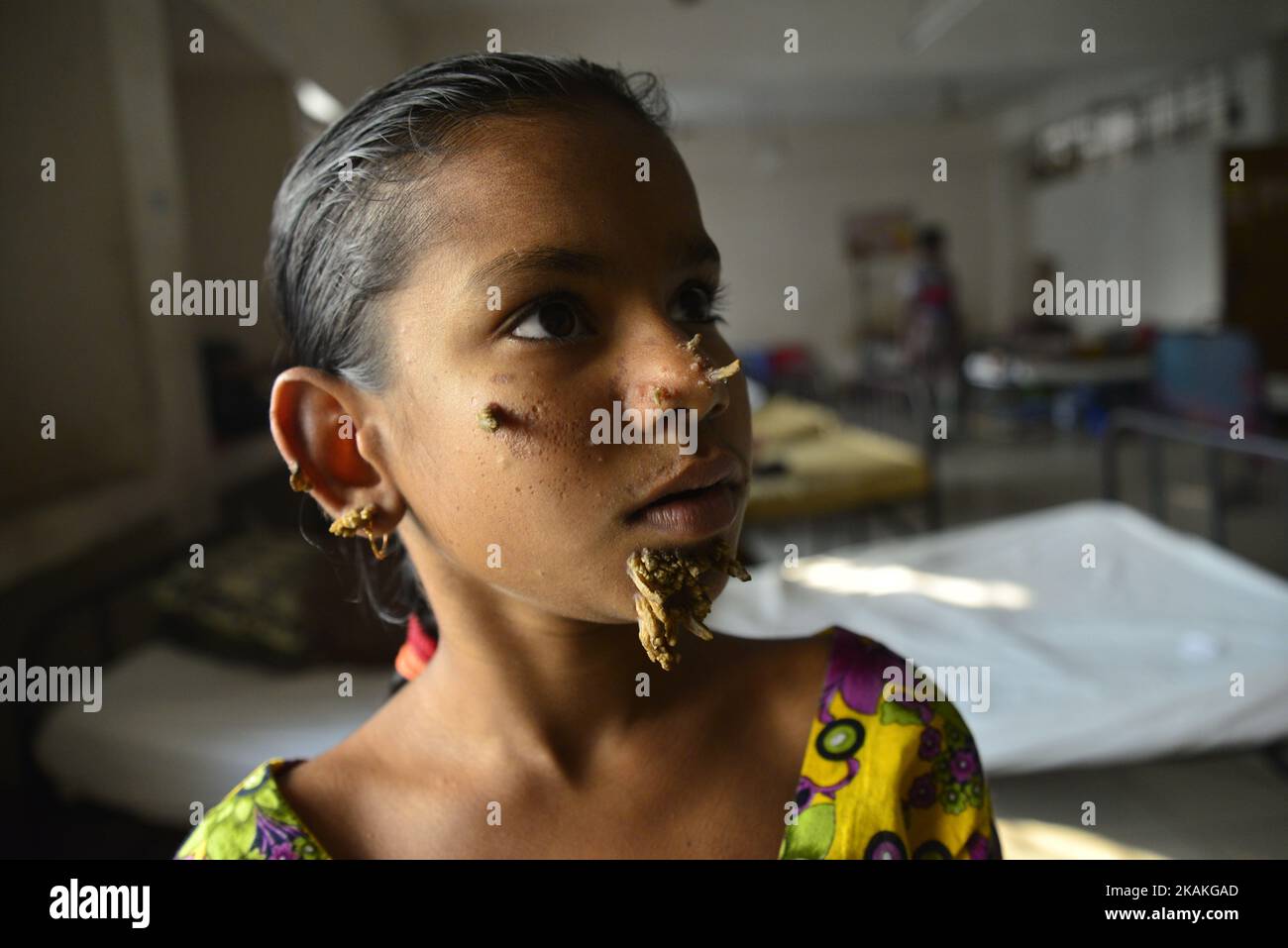 In this photograph taken on January 30, 2017, Bangladeshi patient Sahana Khatun, 10, poses for a photograph at the Dhaka Medical College and Hospital. A young Bangladeshi girl with bark-like warts growing on her face could be the first female ever afflicted by so-called "tree man syndrome", doctors studying the rare condition said January 31. Ten-year-old Sahana Khatun has the tell-tale gnarled growths sprouting from her chin, ear and nose, but doctors at Dhaka's Medical College Hospital are still conducting tests to establish if she has the unusual skin disorder. (Photo by Mamunur Rashid/NurP Stock Photo