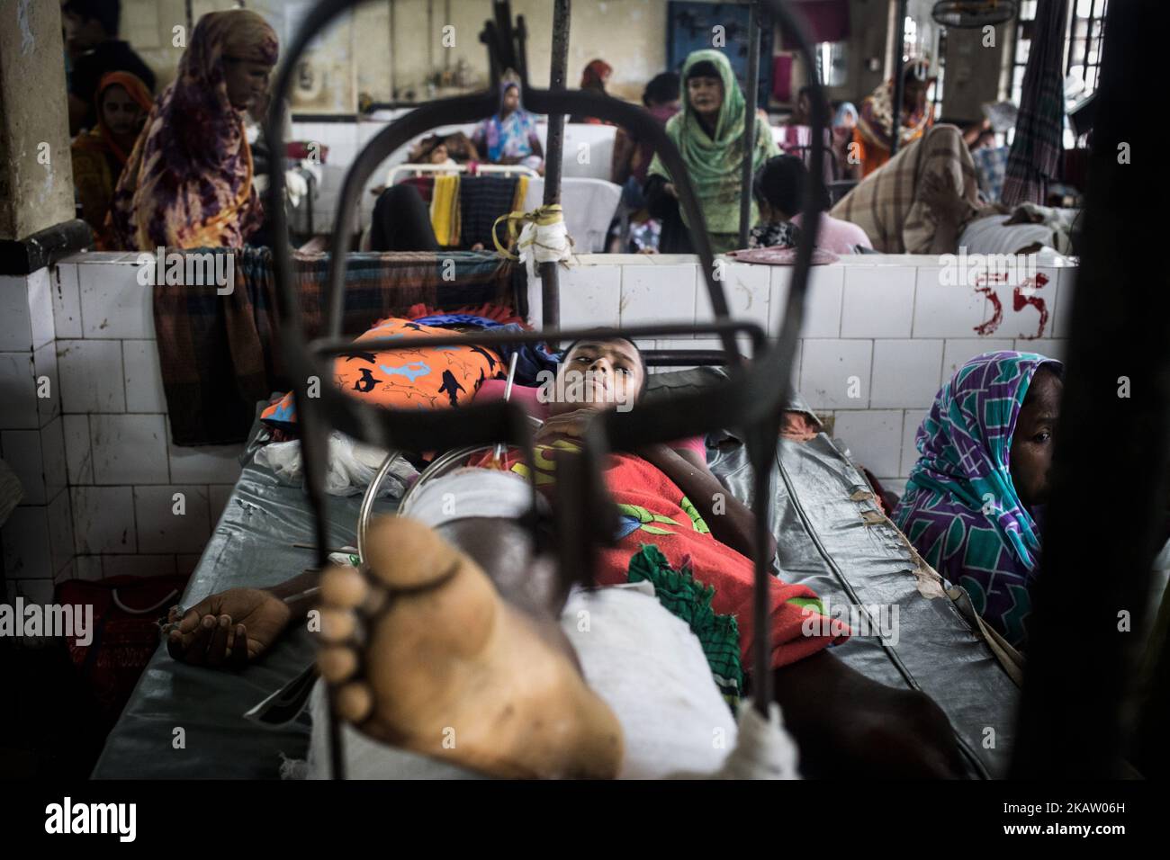 (9/29/2017) A landmine victim Rohingya refugee boy being treated at Chittagong medical college hospital's orthopedic ward. International community already considering this situation in the refugee camps as a state of humanitarian emergency. Bangladesh government, Bangladesh Army, UN agencies, NGOs are involved in continuous relief efforts but it has become almost impossible for them to manage the humanitarian disaster in the Rohingya camps. (Photo by Kazi Riasat/NurPhoto) Stock Photo