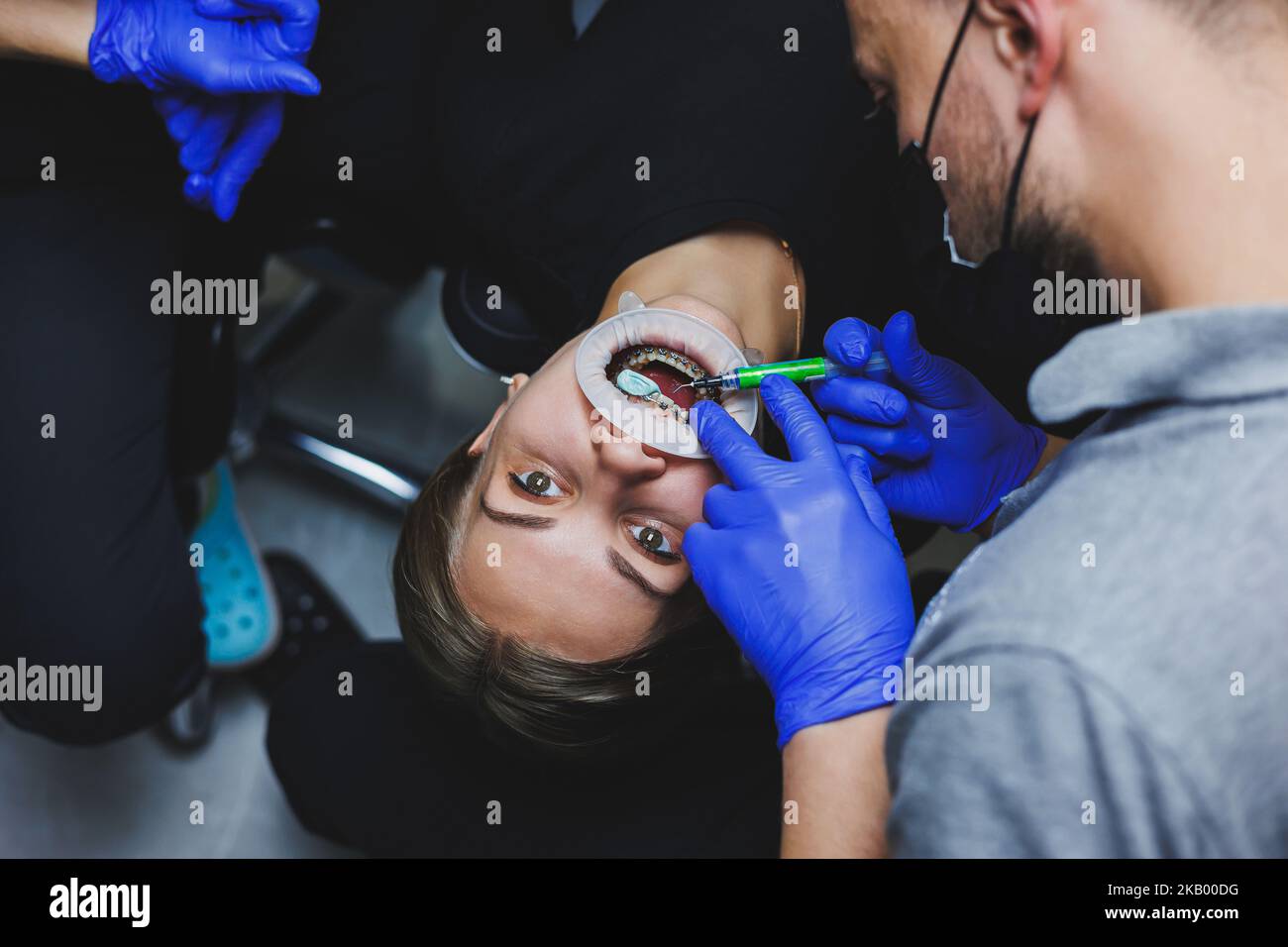 Orthodontic treatment of teeth. Close-up of female teeth with braces ...