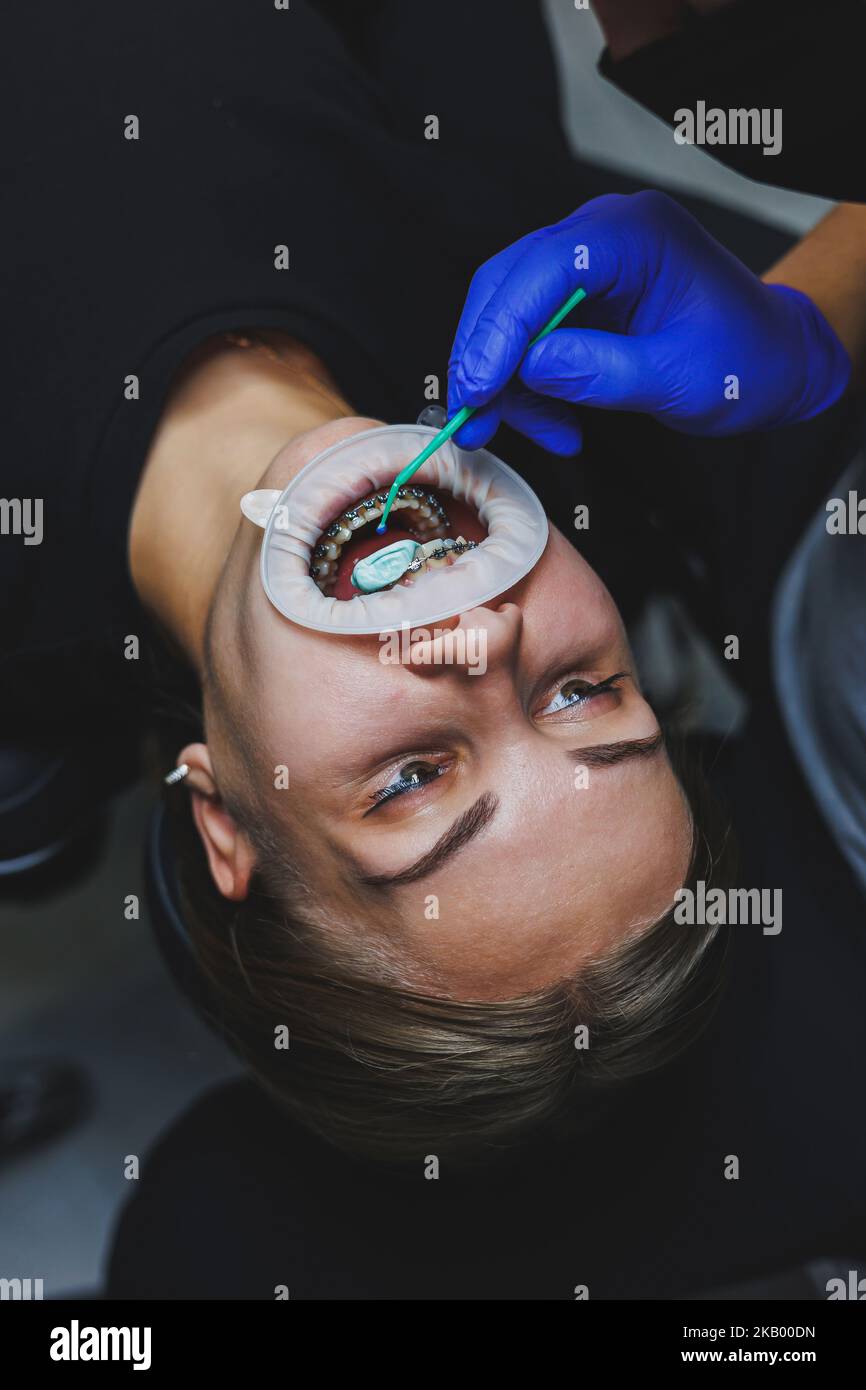 Orthodontic treatment of teeth. Close-up of female teeth with braces ...