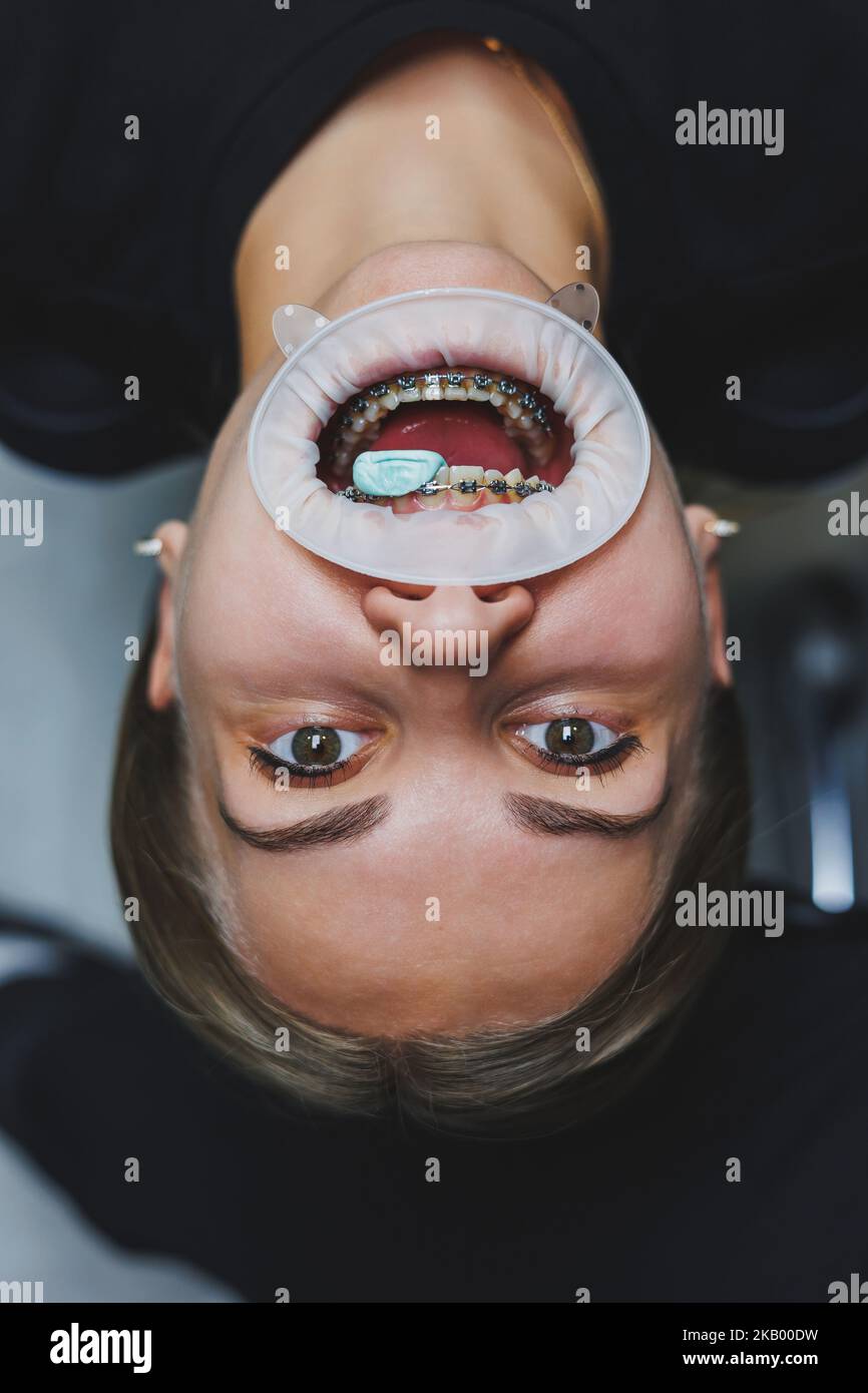 Orthodontic treatment of teeth. Close-up of female teeth with braces ...