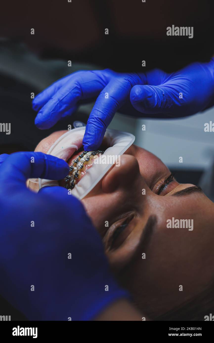 Orthodontic treatment of teeth. Close-up of female teeth with braces ...
