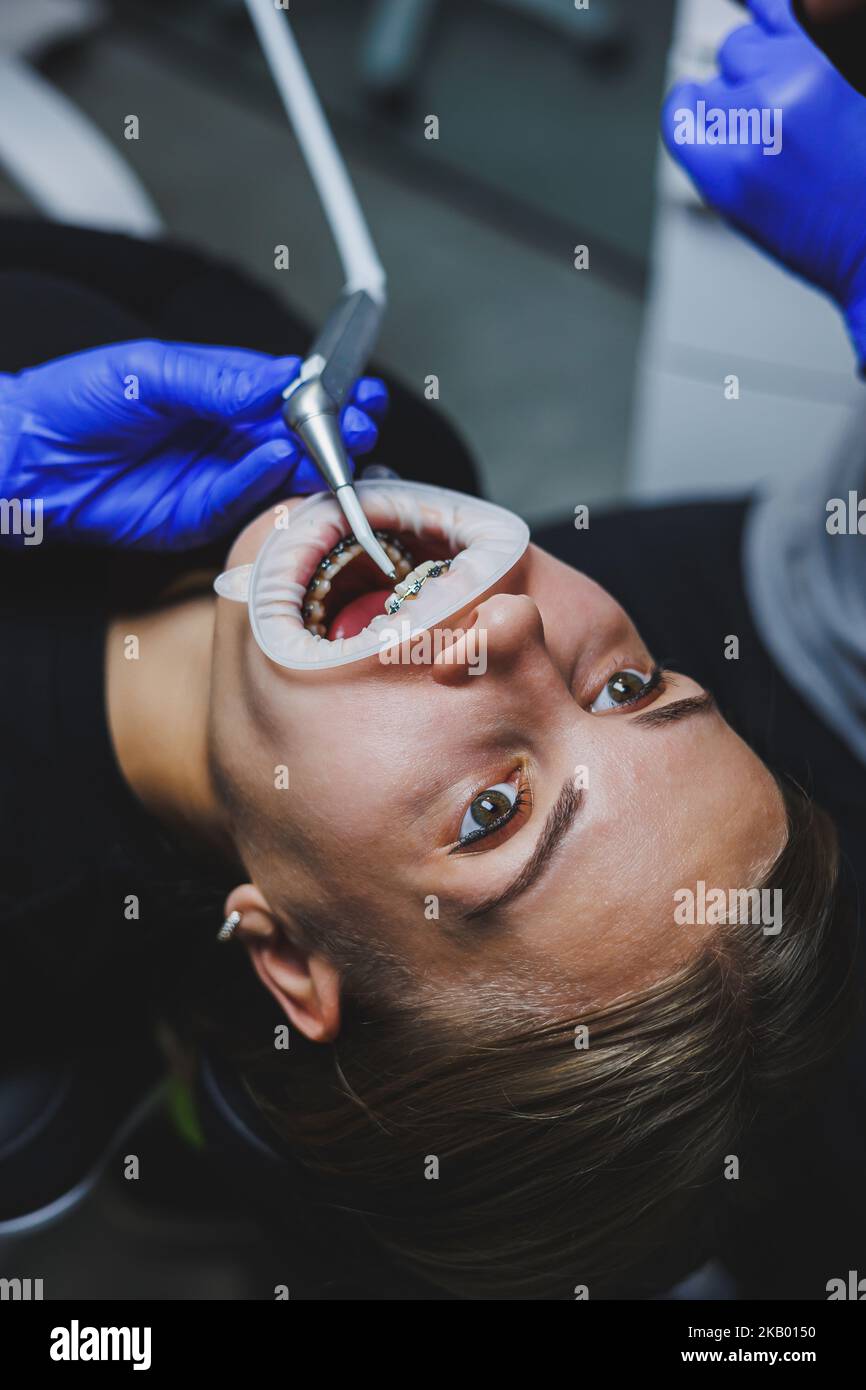 Orthodontic treatment of teeth. Close-up of female teeth with braces ...