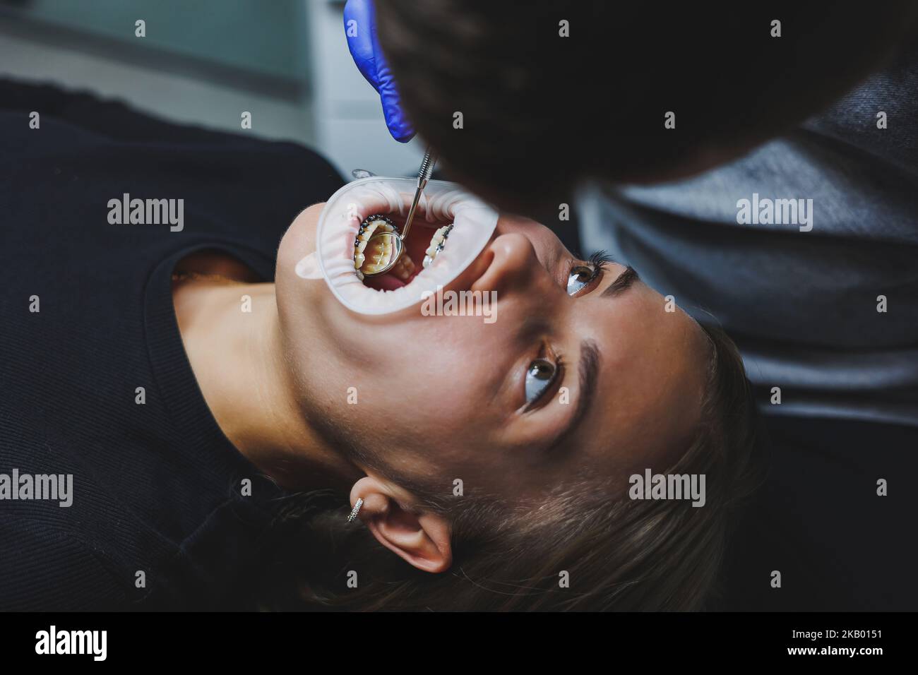 Orthodontic treatment of teeth. Close-up of female teeth with braces ...