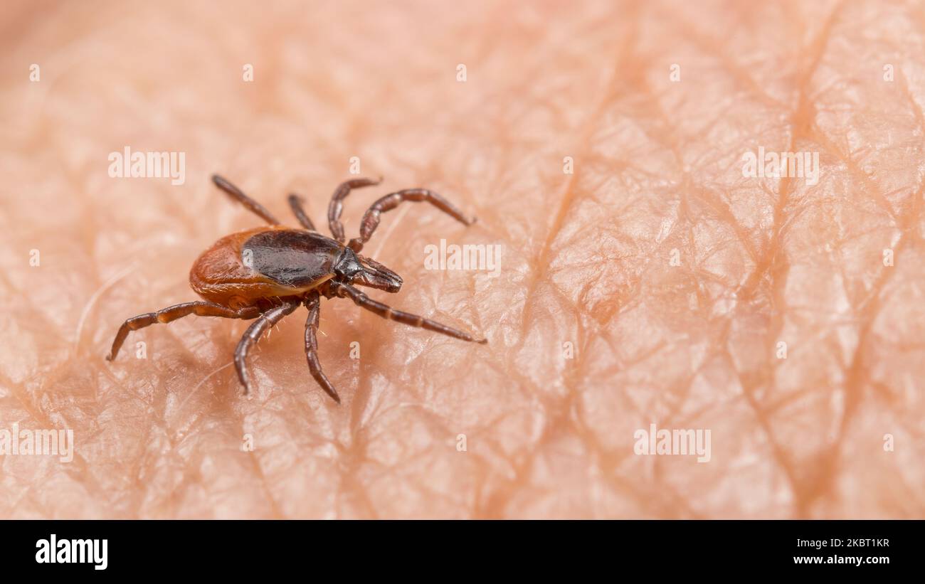 Closeup of female deer tick parasite on human skin background. Ixodes ricinus. Dangerous parasitic insect mite on pink epidermis texture. Lyme disease. Stock Photo