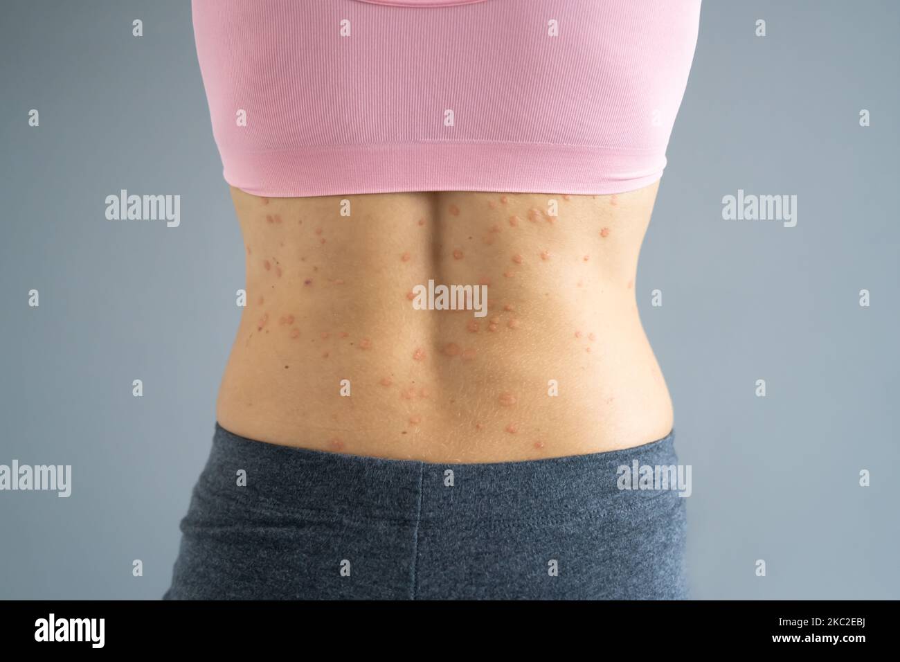 Body Skin With Psoriasis Autoimmune Disease. Medical Illness Stock Photo