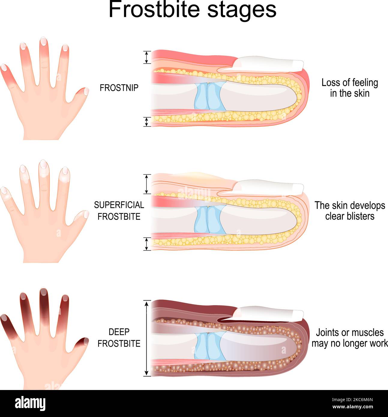 Frostbite stages of fingers. From Frostnip with Loss of feeling in the skin to Deep Frostbite of Joints and muscles. Vector illustration Stock Vector