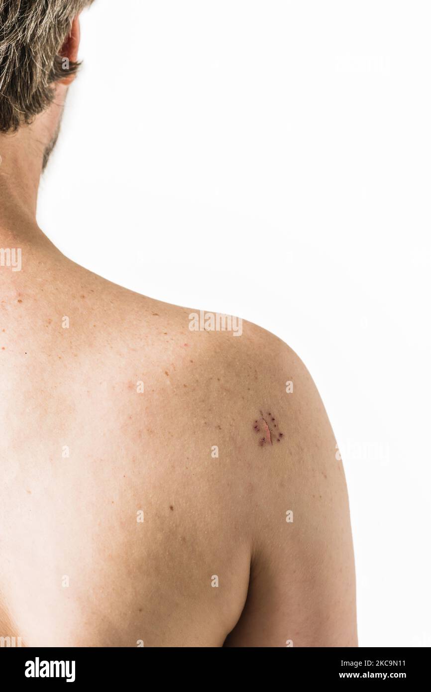 shoulder arthroscopic surgery operation. metal staple suture