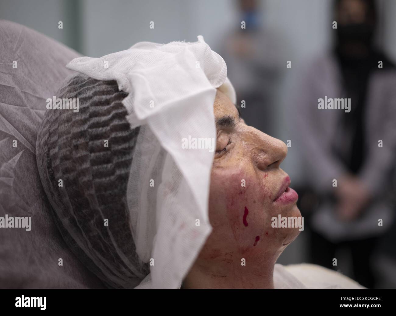 Masoumeh Ataei, who is a victim of an acid attack, after the restorative operation of the fat injection under the skin of her face at the Nilforoushzadeh dermatology clinic in northern Tehran, on June 19, 2021. Ten years ago, one and a half year after Masoumeh Ataei getting a divorce from her husband, lost her face and her sight after an acid attack by her father-in-law but, she had to forgive him because of a personal reason, Now after ten years she has to go to Britain and has to collect 70,000 GBP for the surgery expenses If she wants to regain her sight. (Photo by Morteza Nikoubazl/NurPhot Stock Photo
