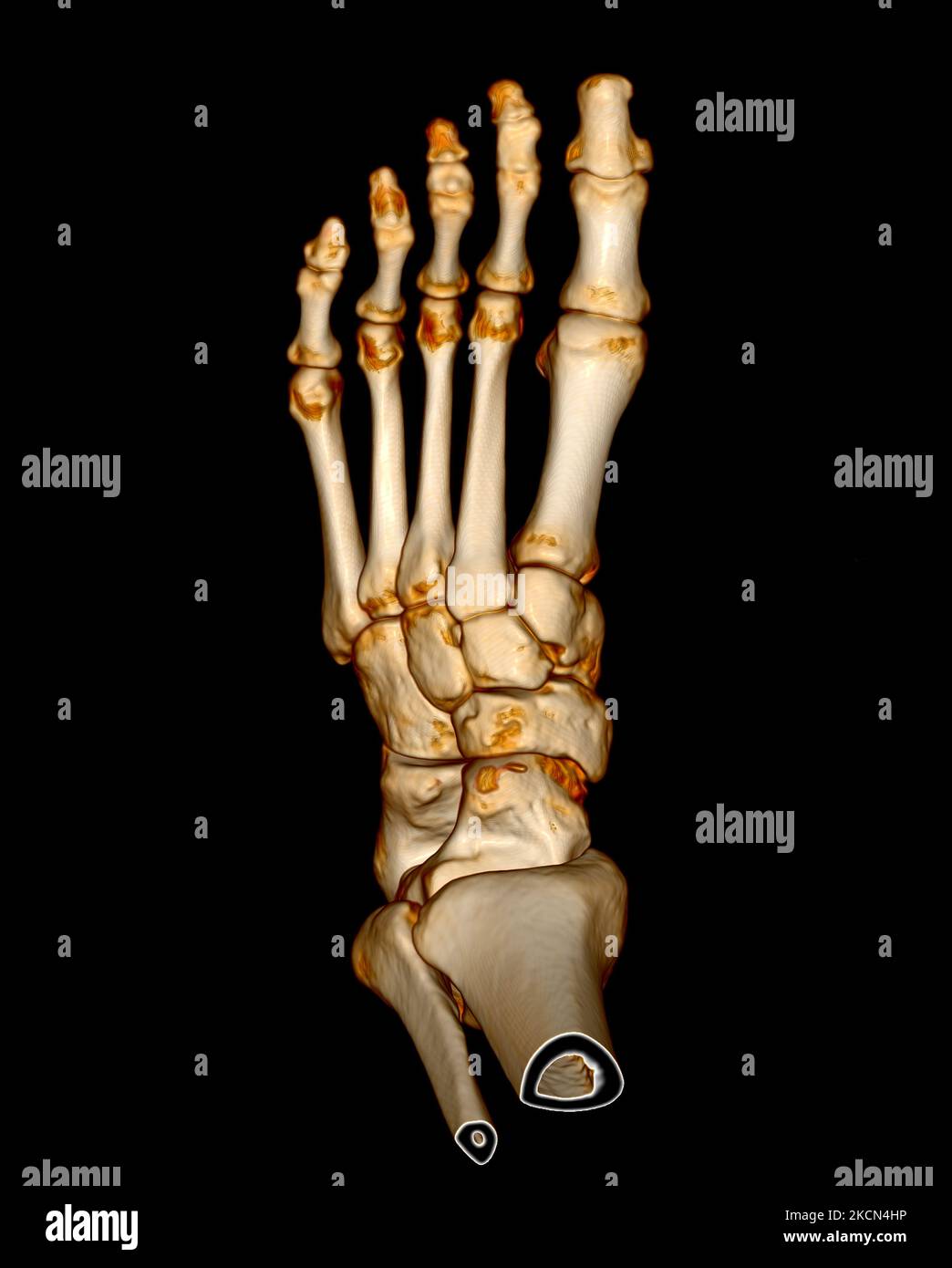 3D rendering of the foot bones for diagnosis bone fracture and