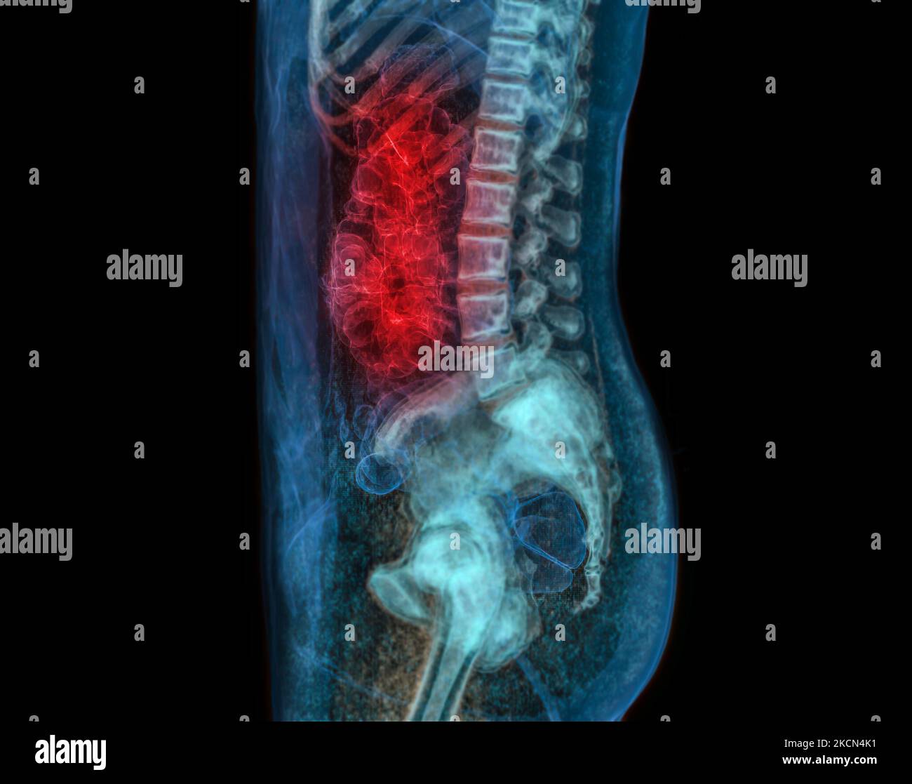 CT Colonography Or CT Scan Of Colon 3D Rendering Image For Screening ...