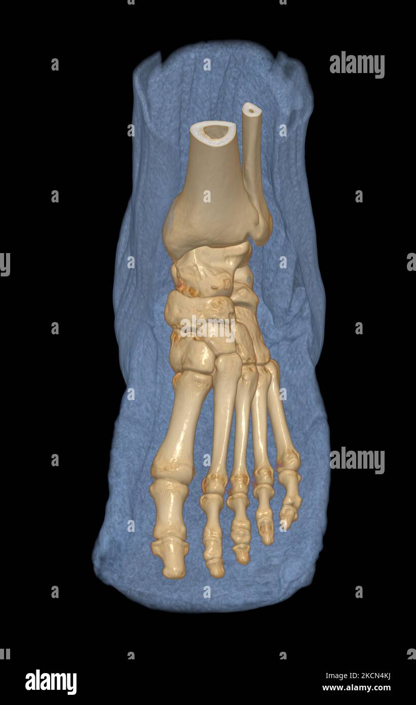 3D rendering of the foot bones for diagnosis bone fracture and