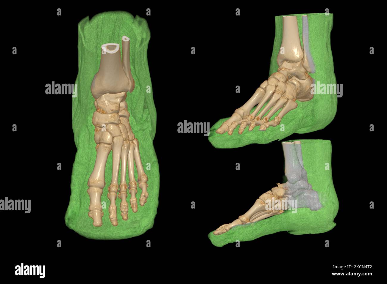 3D rendering  of the foot bones for diagnosis bone fracture and rheumatoid arthritis from CT scannner. Stock Photo