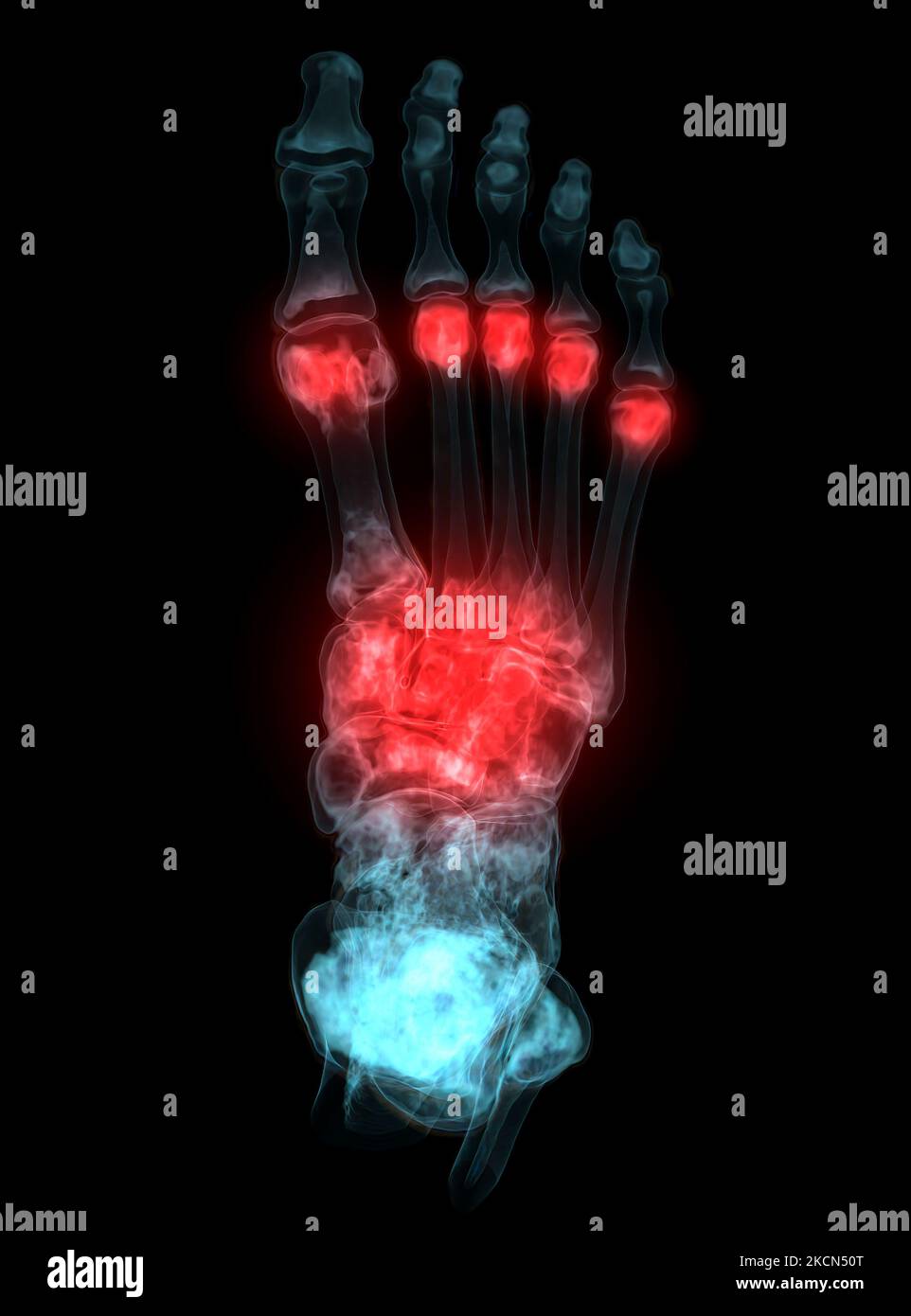 3D rendering of the foot bones for diagnosis bone fracture and