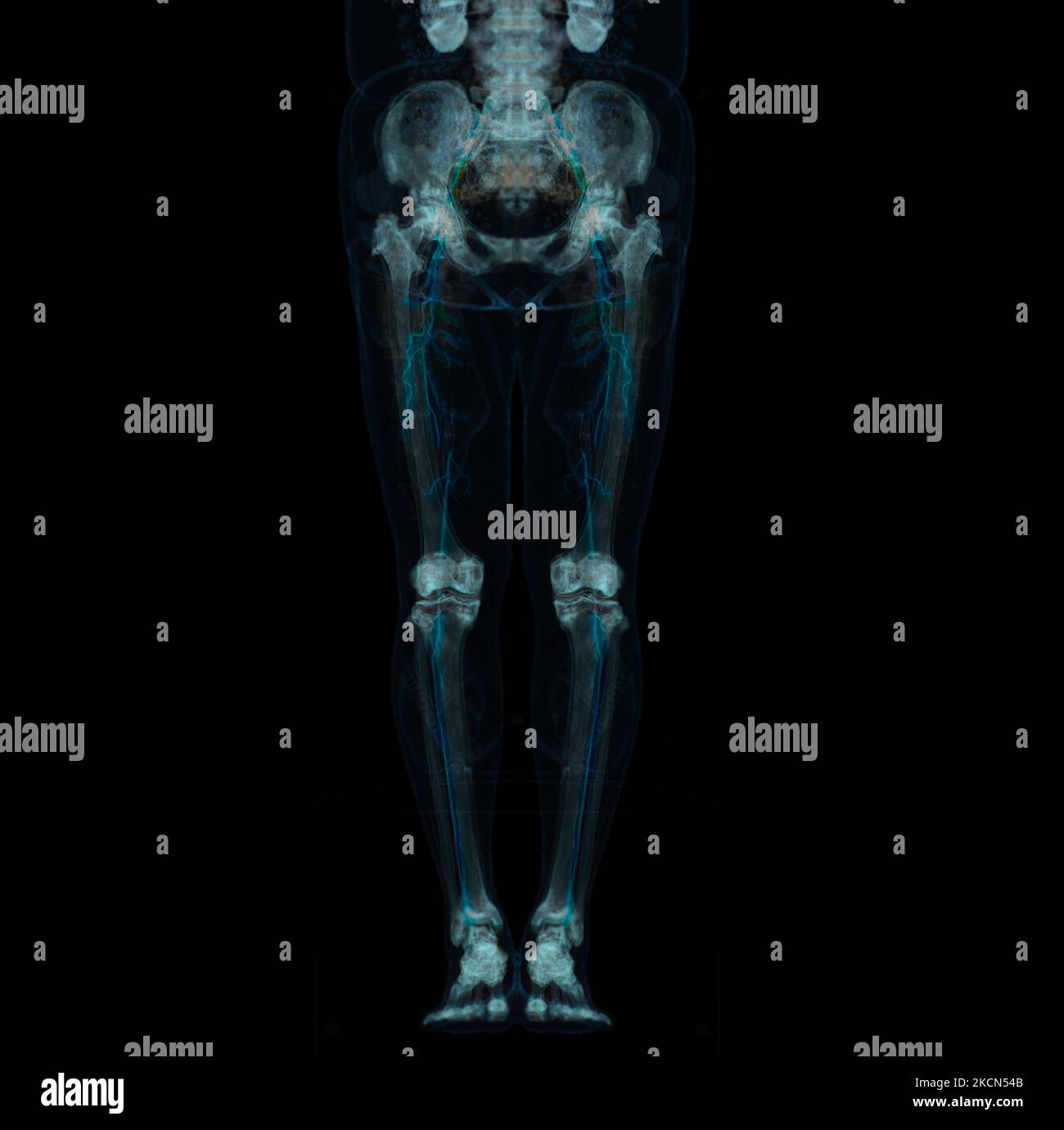 CT scan of lower extremity ,3D illustration of Femur bone , knee joint ...