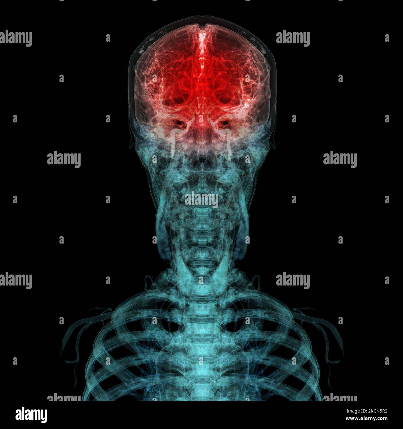 3D rendered medically accurate illustration of the cerebral artery of