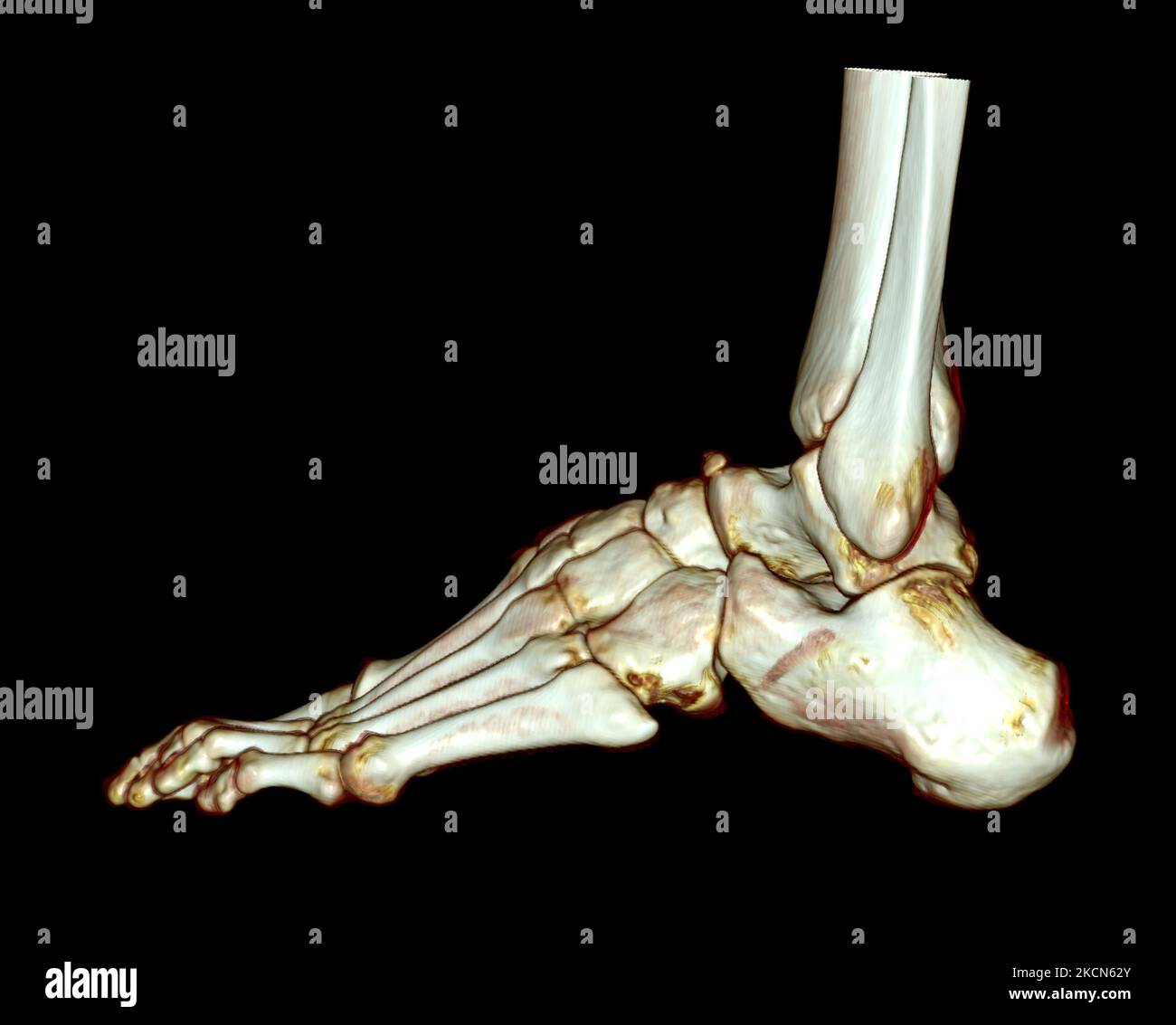 3D rendering of the foot bones for diagnosis bone fracture and