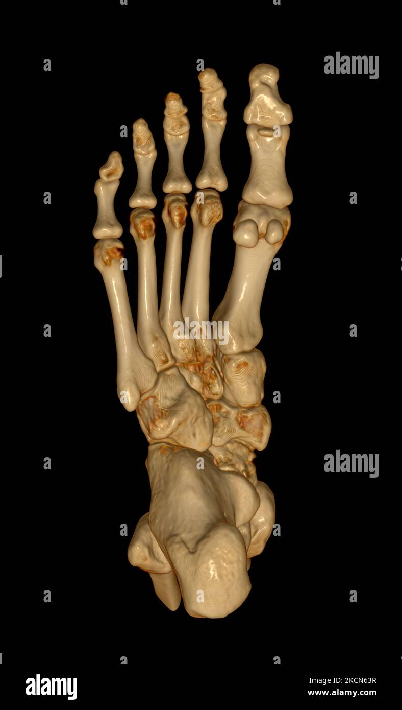 3D rendering of the foot bones for diagnosis bone fracture and