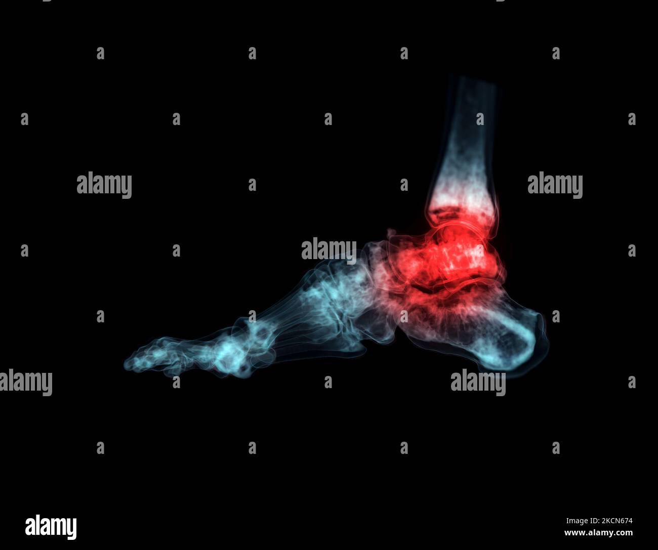 3D rendering of the foot bones for diagnosis bone fracture and
