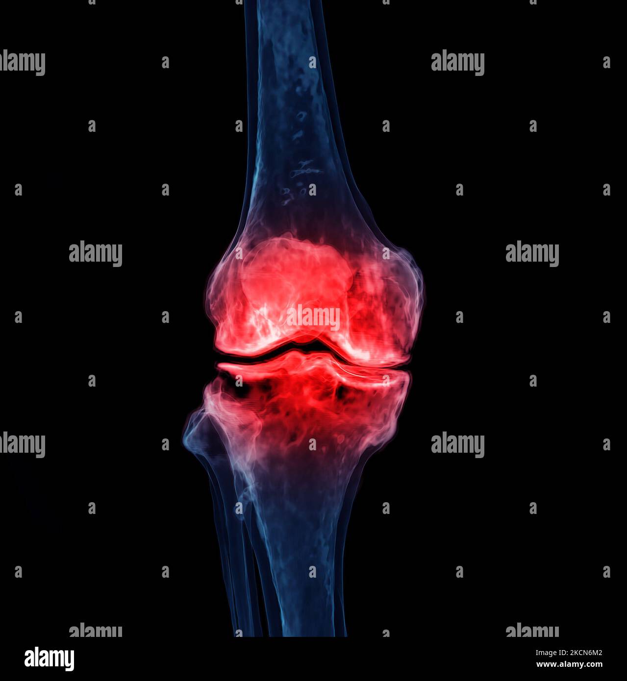 3d renderering of the knee joint isolated on black background Showing