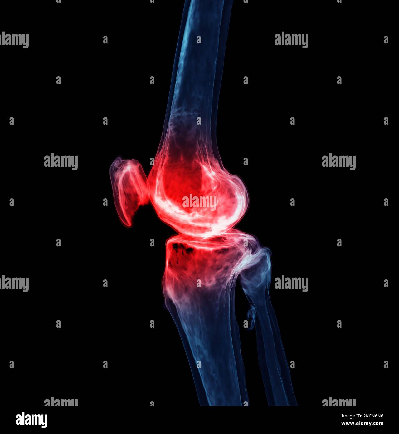 3d renderering of the knee joint isolated on black background Showing