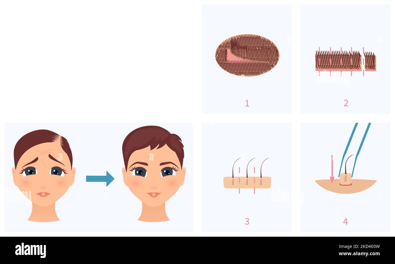 FUT hair loss treatment, conceptual illustration Stock Photo