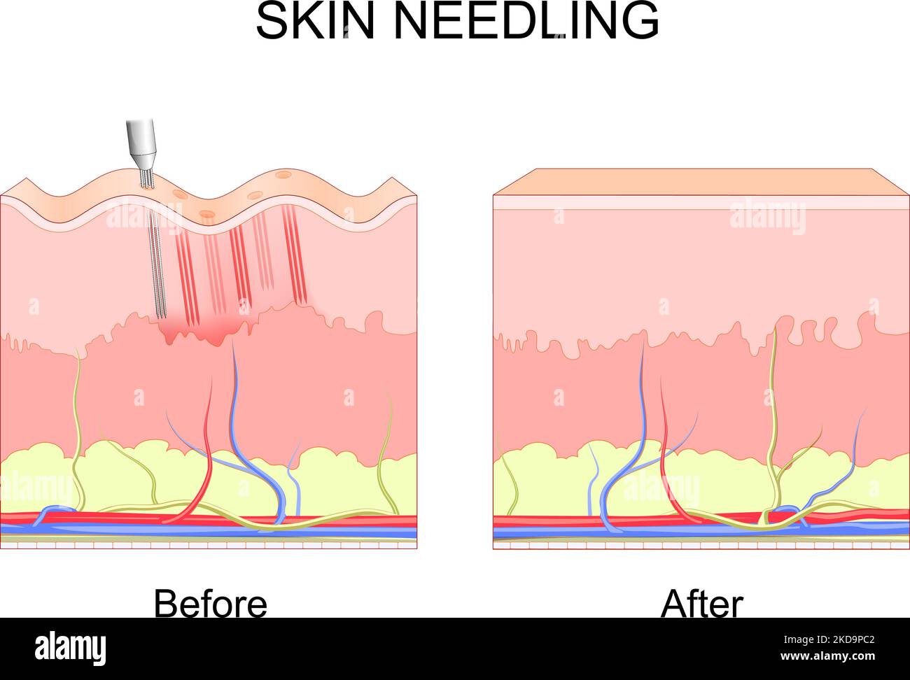 microneedling. skin needling. Before and after cosmetic procedure. Cross section of layers of a human skin with wrinkles. Close-up of Process Stock Vector